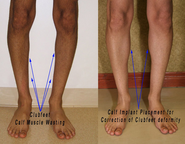 Clubfoot Correction With Implants Calf Implants Los Angeles Clubfoot Correction With Implants Calf Implants Los Angeles