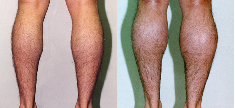 male patient before and after calf augmentation