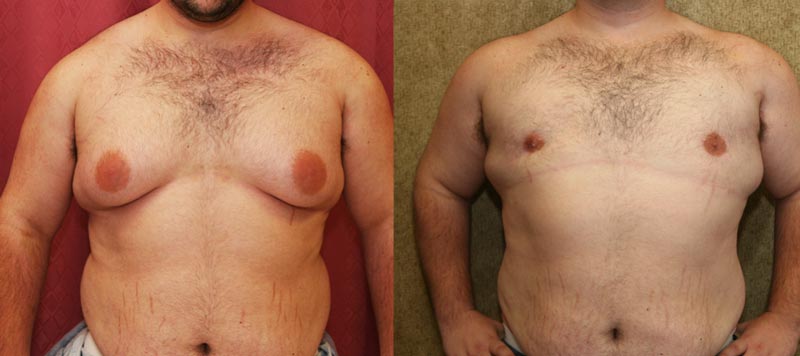 Gynecomastia Surgery in Beverly Hills & Los Angeles