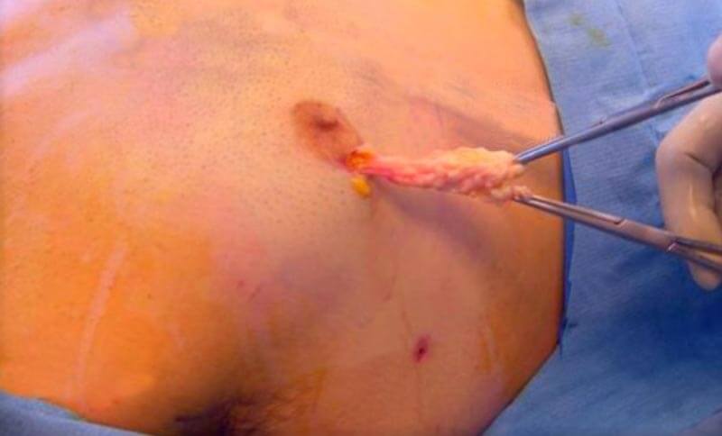 Male Breast Reduction Los Angeles Gynecomastia Surgery
