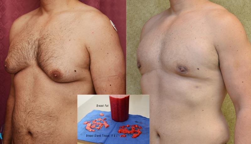 Gynecomastia Treatment Before After Photos Beverly Hills