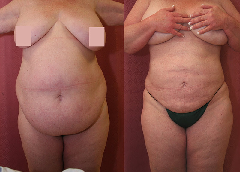 Chicago's Best Flank Fat Removal: Get Results Without Liposuction