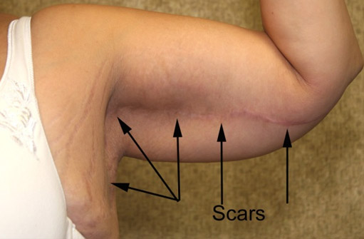 Brachioplasty Arm Lift Hidden Scar Visible