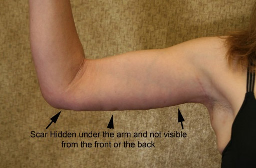 Brachioplasty Arm Lift Hidden Scar Hidden