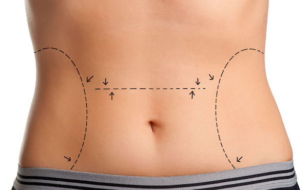 tummy tuck procedure scars