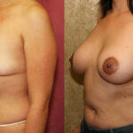 Breast Lift - Moderate Before & After Patient #12650