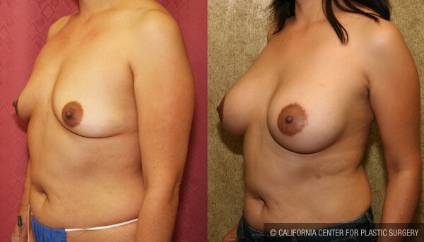 Breast Lift - Moderate Before & After Patient #12650