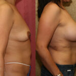 Breast Lift - Moderate Before & After Patient #12650