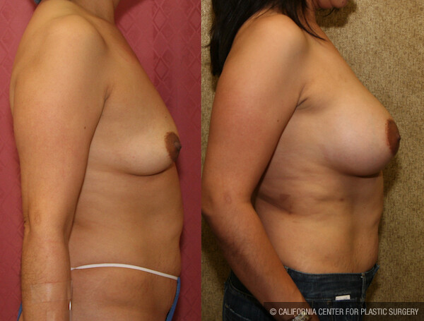Breast Lift - Moderate Before & After Patient #12650