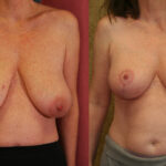 Breast Lift - Full Before & After Patient #12646