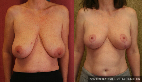 Full Breast Lift Before & After Patient #12646