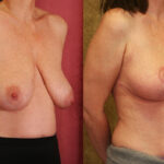 Breast Lift - Full Before & After Patient #12646