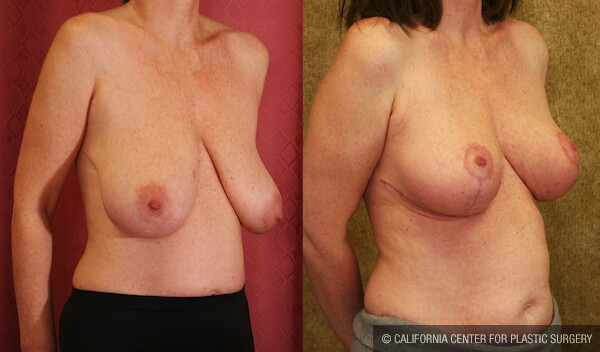 Breast Lift - Full Before & After Patient #12646