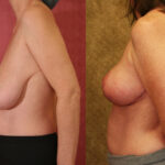 Breast Lift - Full Before & After Patient #12646