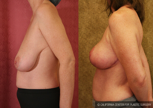 Breast Lift - Full Before & After Patient #12646