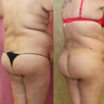 Buttock Lift/Augmentation Before & After Patient #12630