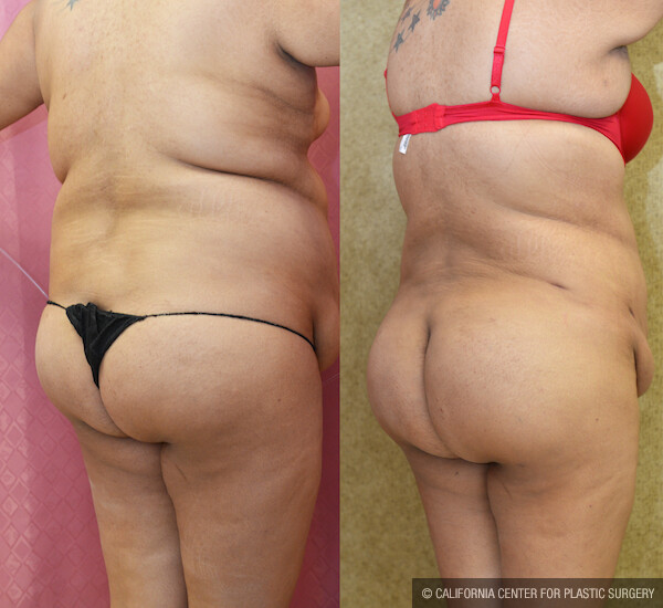 Buttock Lift/Augmentation Before & After Patient #12630