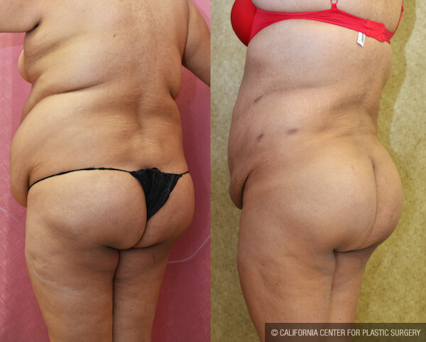 Buttock Lift/Augmentation Before & After Patient #12630