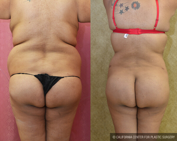 Buttock Lift/Augmentation Before & After Patient #12630