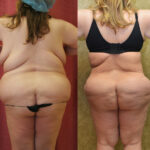 Buttock Lift/Augmentation Before & After Patient #12628