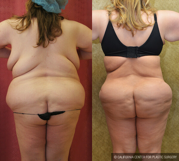 Buttock Lift/Augmentation Before & After Patient #12628