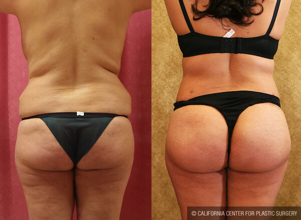 Buttock Lift/Augmentation Before & After Patient #12624