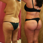 Buttock Lift/Augmentation Before & After Patient #12624
