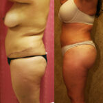 Buttock Lift/Augmentation Before & After Patient #12624