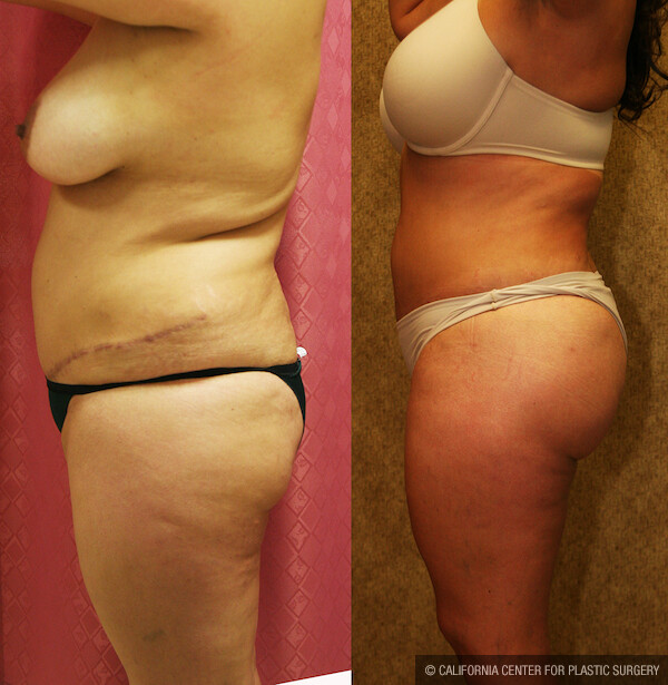 Buttock Lift/Augmentation Before & After Patient #12624