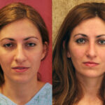 Rhinoplasty - Caucasian Before & After Patient #12575