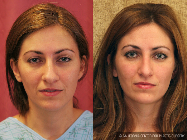 Rhinoplasty - Caucasian Before & After Patient #12575
