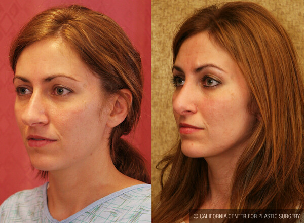 Rhinoplasty - Caucasian Before & After Patient #12575