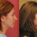 Rhinoplasty - Caucasian Before & After Patient #12575