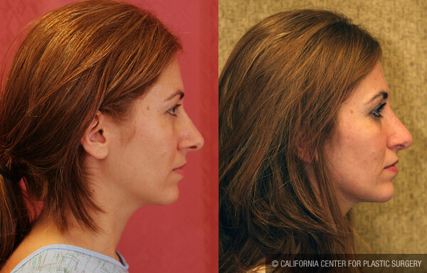 Rhinoplasty - Caucasian Before & After Patient #12575