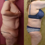 Tummy Tuck (Abdominoplasty) Plus Size Before & After Patient #12543