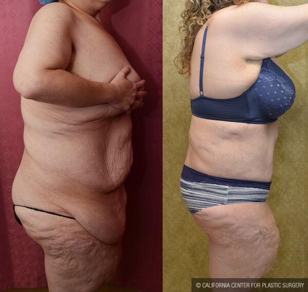 Tummy Tuck Plus Size Before & After Patient #12543