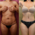 Tummy Tuck (Abdominoplasty) Small Size Before & After Patient #12541