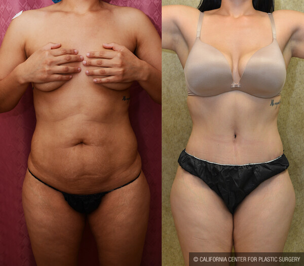 Tummy Tuck (Abdominoplasty) Small Size Before & After Patient #12541