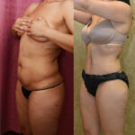 Tummy Tuck (Abdominoplasty) Small Size Before & After Patient #12541