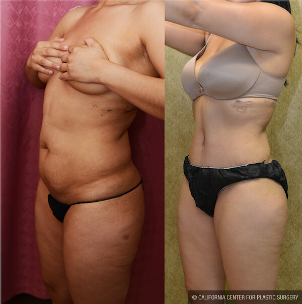 Tummy Tuck (Abdominoplasty) Small Size Before & After Patient #12541