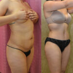 Tummy Tuck (Abdominoplasty) Small Size Before & After Patient #12541