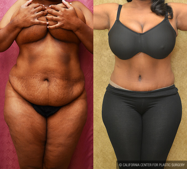 African American Tummy Tuck Before & After Patient #12566