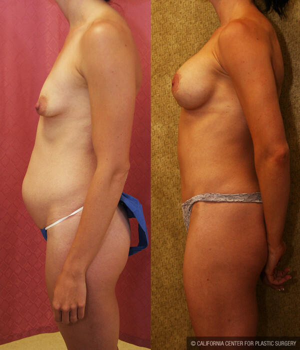 Mommy Makeover Before & After Patient #12561