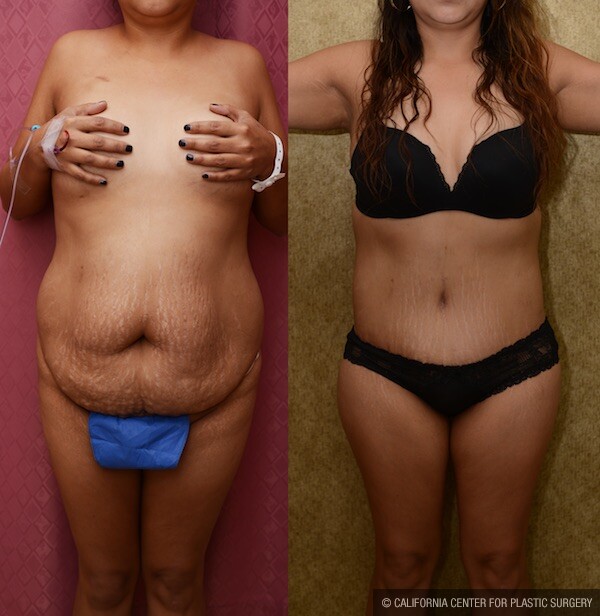 Tummy Tuck Medium Size Before & After Patient #12545