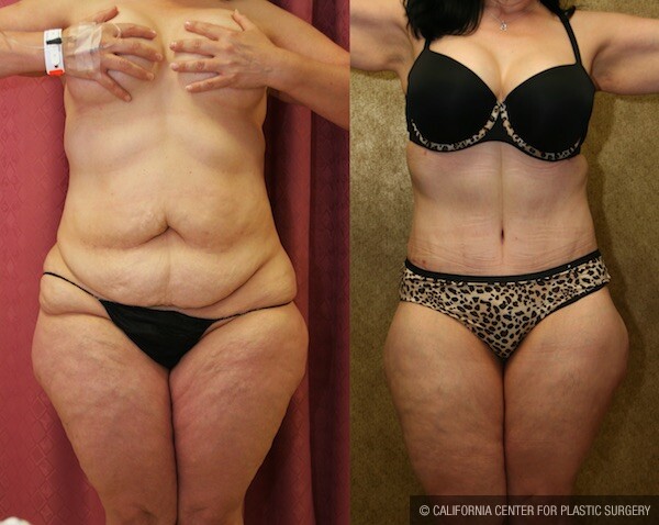 Tummy Tuck Medium Size Before & After Patient #12544