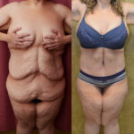 Tummy Tuck (Abdominoplasty) Plus Size Before & After Patient #12543