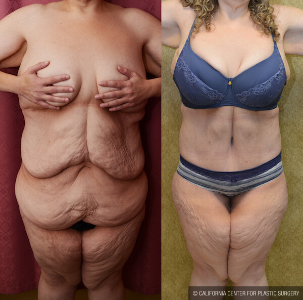 Tummy Tuck (Abdominoplasty) Plus Size Before & After Patient #12543