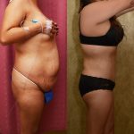 Tummy Tuck (Abdominoplasty) Plus Size Before & After Patient #12673