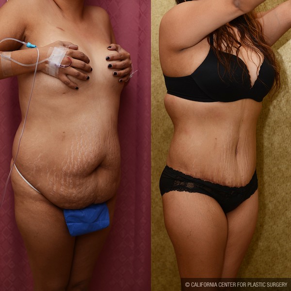 Tummy Tuck (Abdominoplasty) Plus Size Before & After Patient #12673