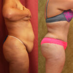 Tummy Tuck (Abdominoplasty) Plus Size Before & After Patient #12654